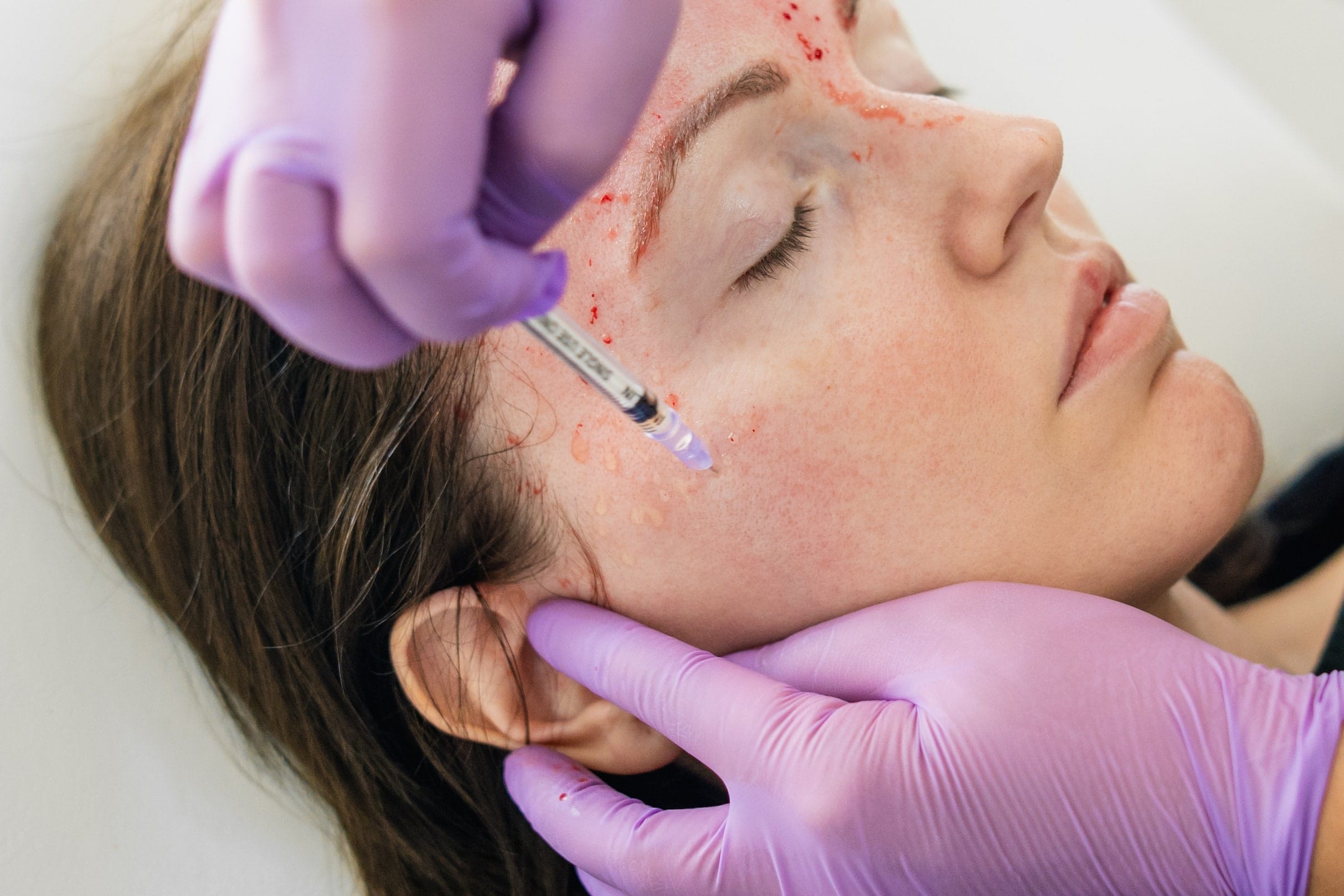 woman getting prp vampire facial done